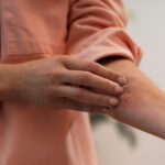 person-dealing-with-rosacea